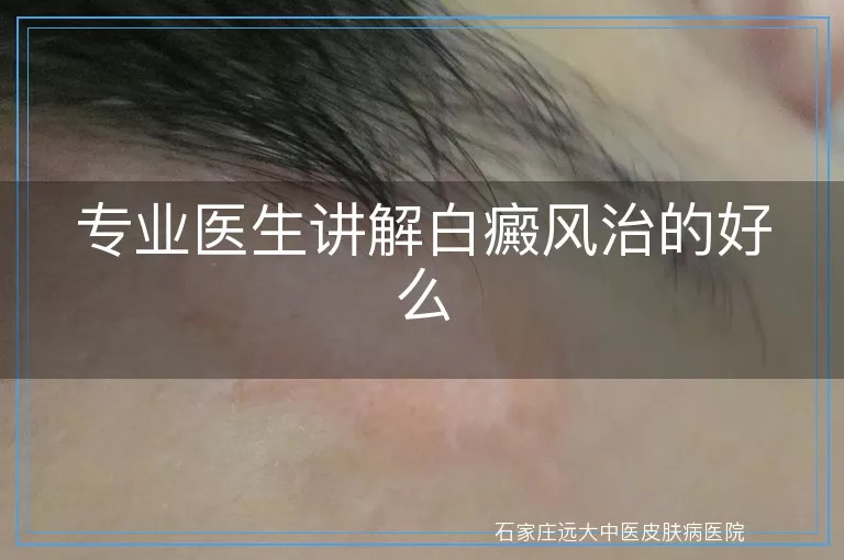 专业医生讲解白癜风治的好么