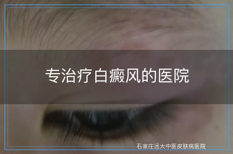 专治疗白癜风的医院