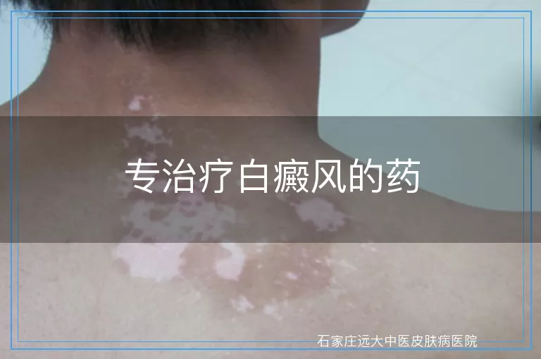 专治疗白癜风的药