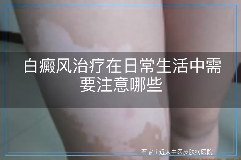 白癜风治疗在日常生活中需要注意哪些