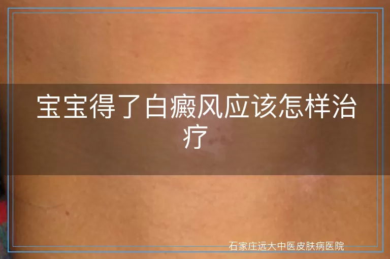 宝宝得了白癜风应该怎样治疗