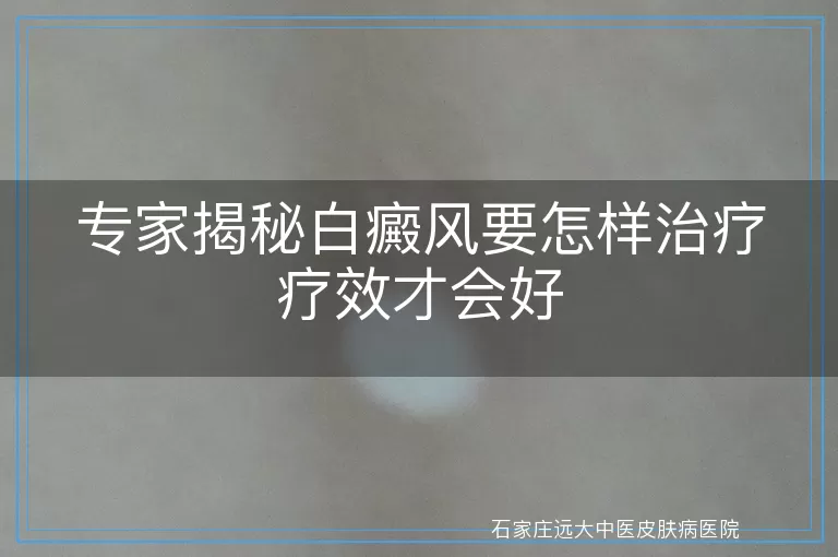 专家揭秘白癜风要怎样治疗疗效才会好