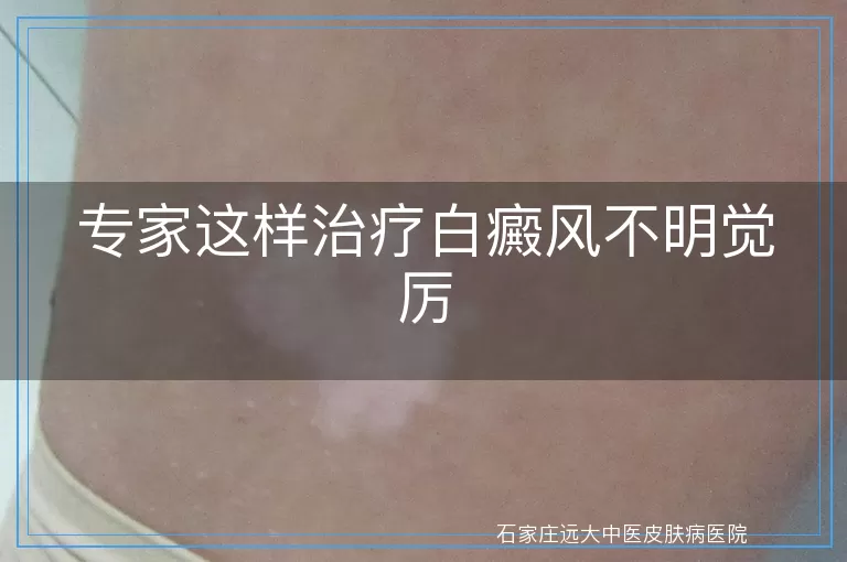 专家这样治疗白癜风不明觉厉