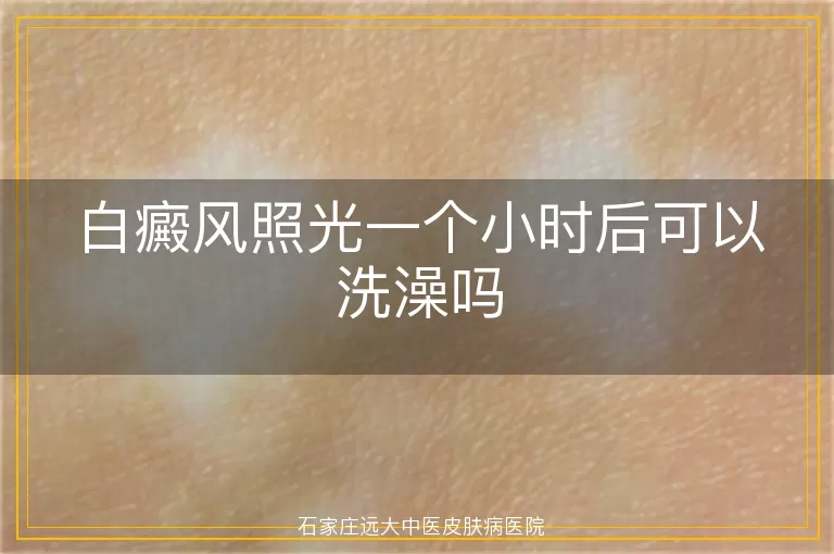 白癜风照光一个小时后可以洗澡吗