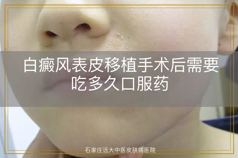 白癜风表皮移植手术后需要吃多久口服药