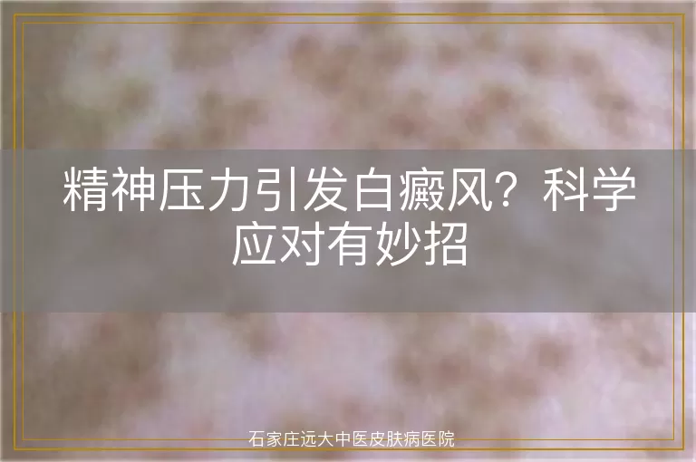 精神压力引发白癜风?科学应对有妙招