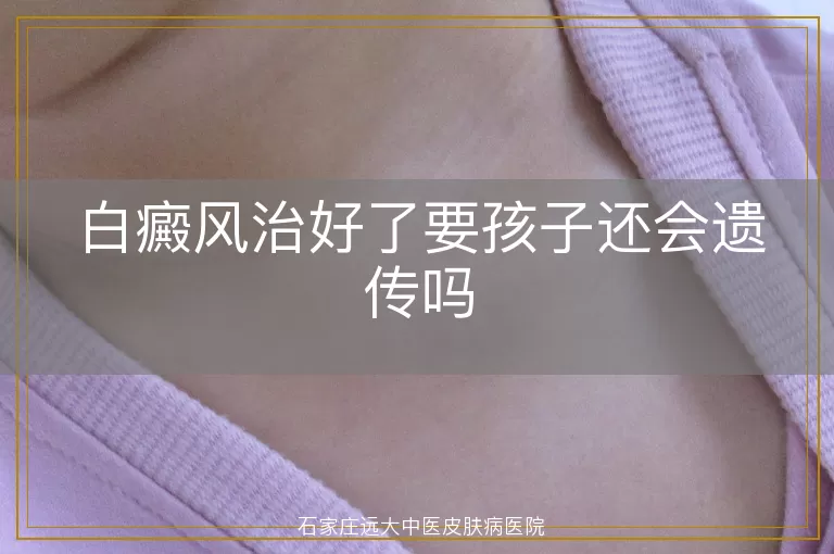 白癜风治好了要孩子还会遗传吗