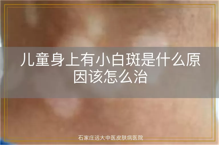 儿童身上有小白斑是什么原因该怎么治