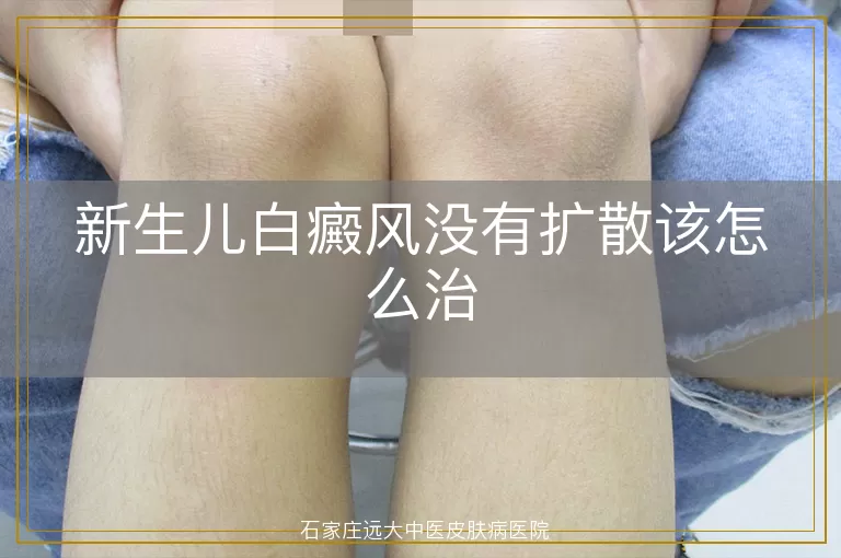 新生儿白癜风没有扩散该怎么治