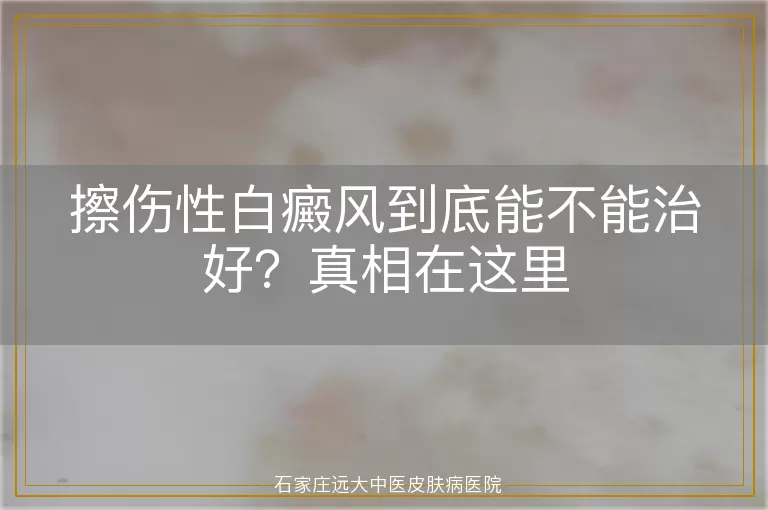 擦伤性白癜风到底能不能治好？真相在这里
