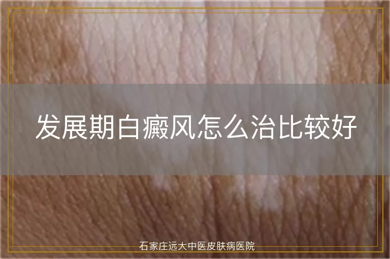 发展期白癜风怎么治比较好