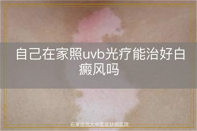 自己在家照uvb光疗能治好白癜风吗