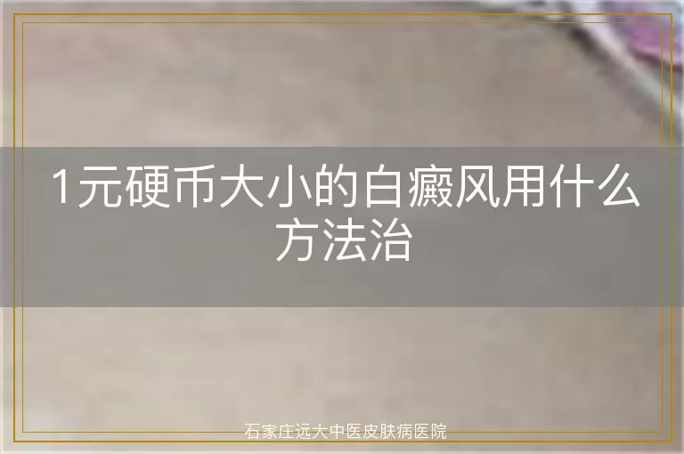 1元硬币大小的白癜风用什么方法治