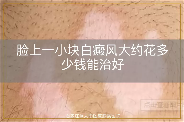 脸上一小块白癜风大约花多少钱能治好