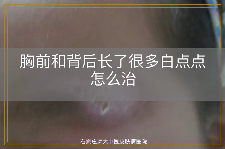 胸前和背后长了很多白点点怎么治