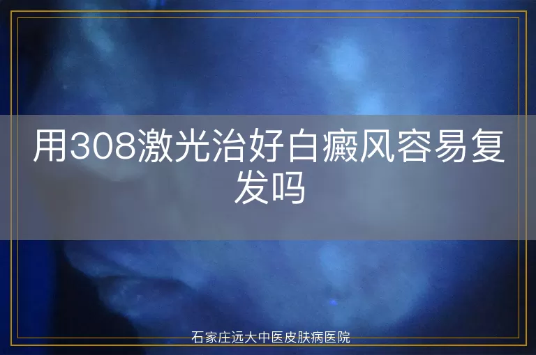 用308激光治好白癜风容易复发吗