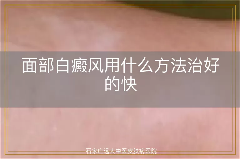 面部白癜风用什么方法治好的快