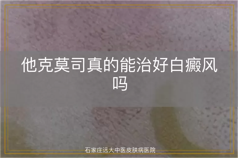 他克莫司真的能治好白癜风吗