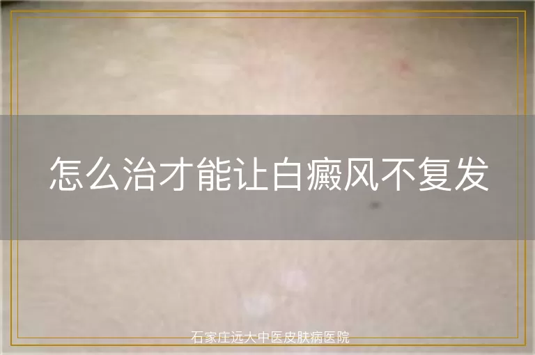 怎么治才能让白癜风不复发