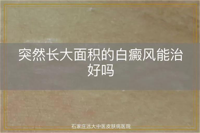 突然长大面积的白癜风能治好吗