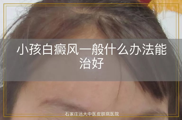 小孩白癜风一般什么办法能治好