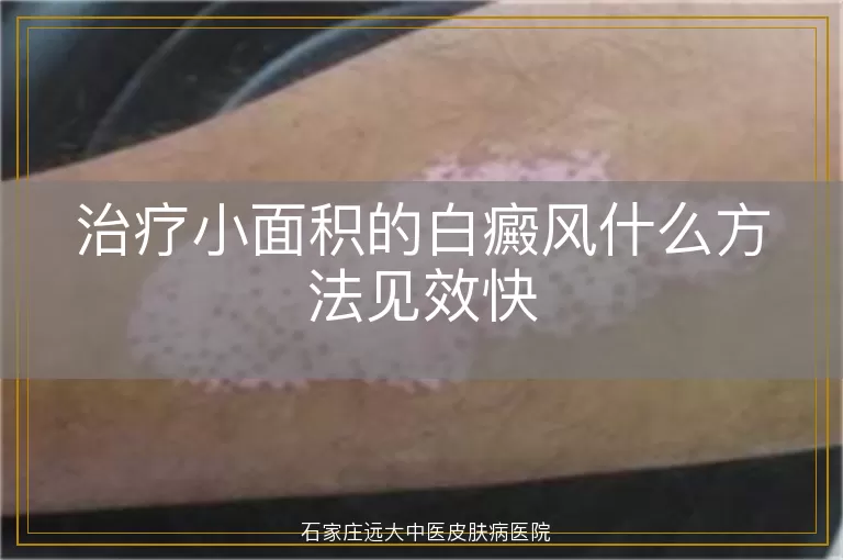 治疗小面积的白癜风什么方法见效快