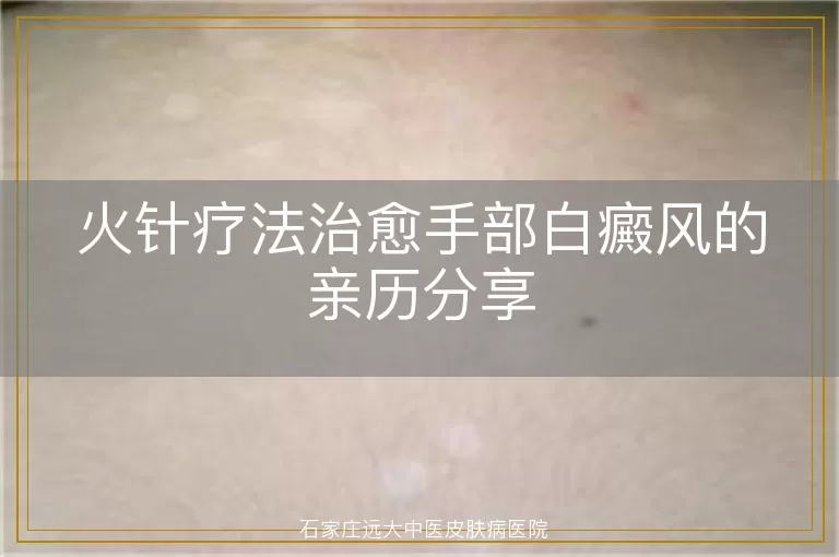 火针疗法治愈手部白癜风的亲历分享