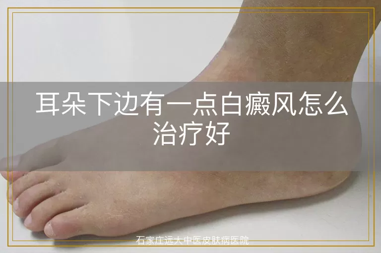 耳朵下边有一点白癜风怎么治疗好