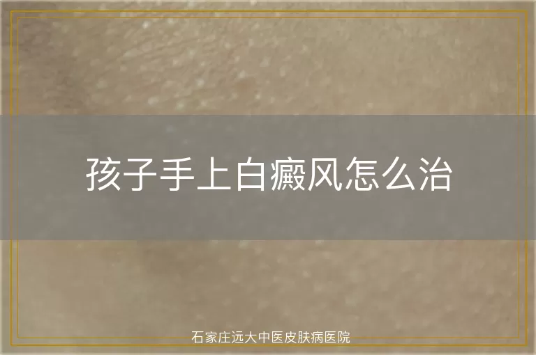 孩子手上白癜风怎么治