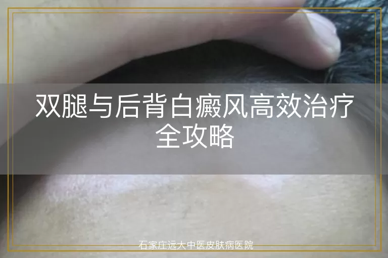 双腿与后背白癜风高效治疗全攻略