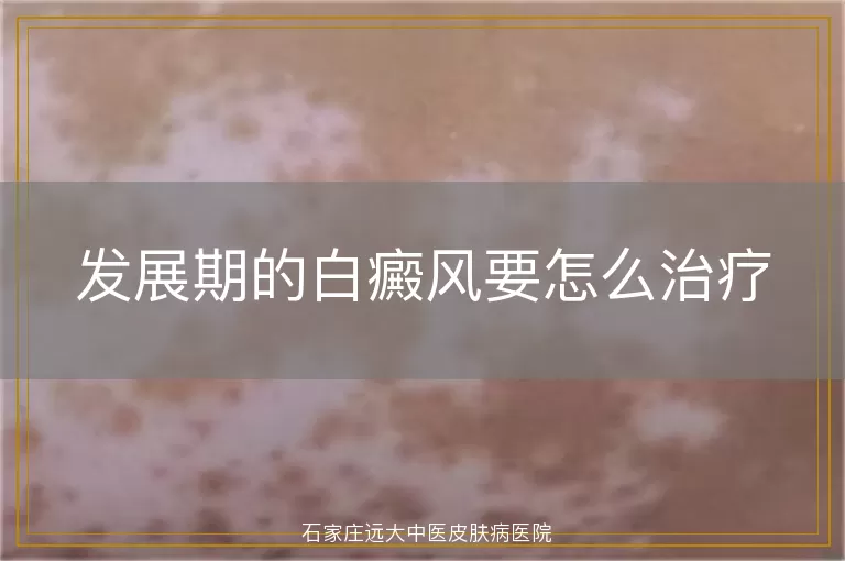 发展期的白癜风要怎么治疗