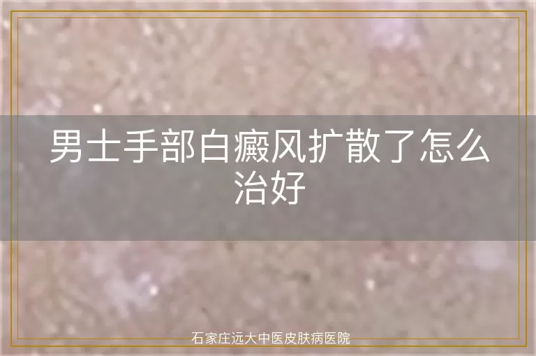 男士手部白癜风扩散了怎么治好