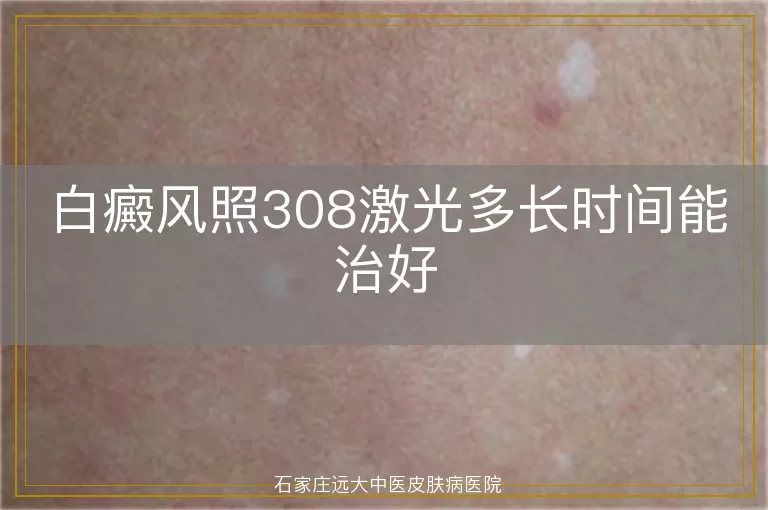 白癜风照308激光多长时间能治好