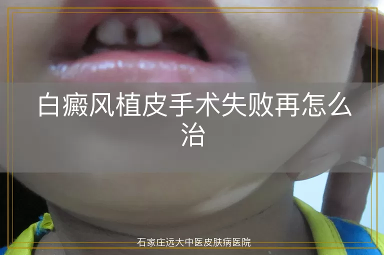 白癜风植皮手术失败再怎么治