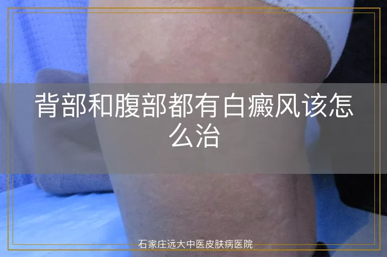 背部和腹部都有白癜风该怎么治