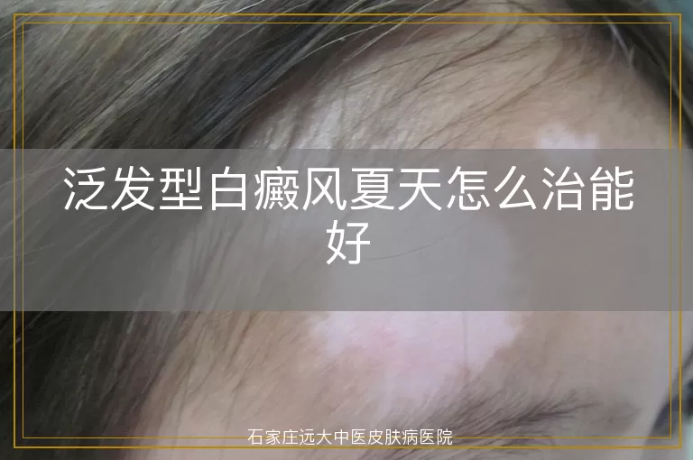 泛发型白癜风夏天怎么治能好