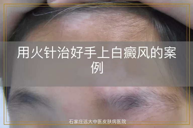 用火针治好手上白癜风的案例