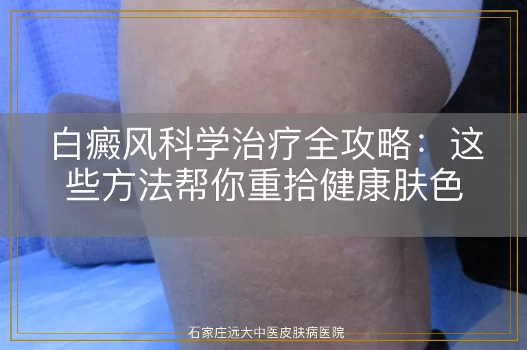 白癜风科学治疗全攻略：这些方法帮你重拾健康肤色