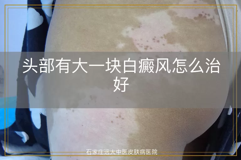 头部有大一块白癜风怎么治好