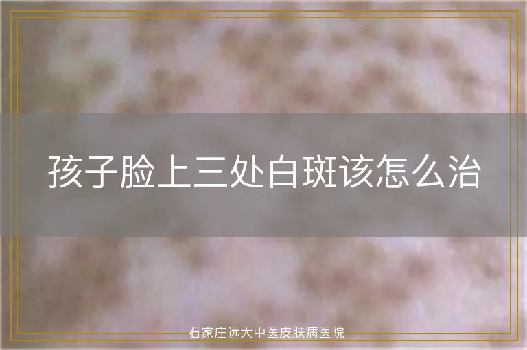 孩子脸上三处白斑该怎么治