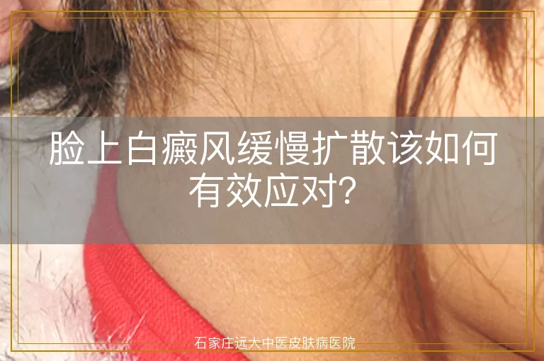 脸上白癜风缓慢扩散该如何有效应对？