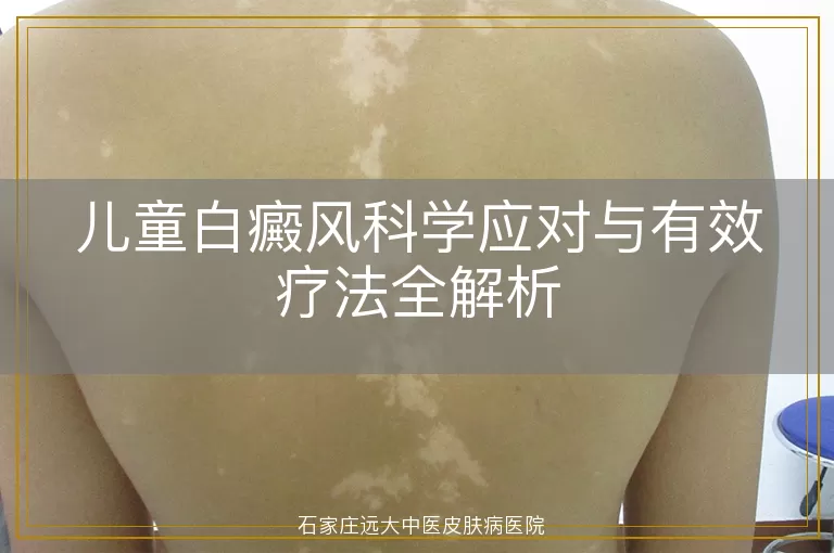 儿童白癜风科学应对与有效疗法全解析