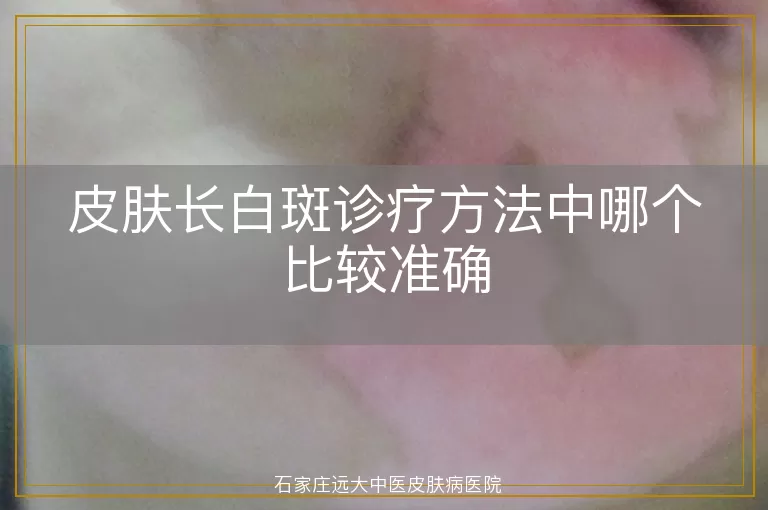 皮肤长白斑诊疗方法中哪个比较准确