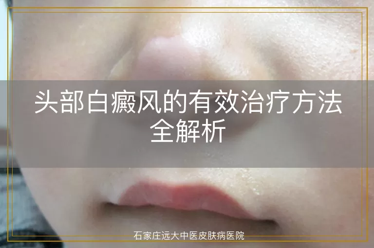 头部白癜风的有效治疗方法全解析