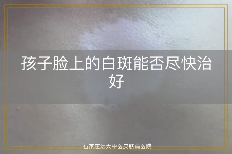 孩子脸上的白斑能否尽快治好