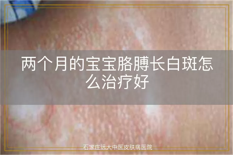 两个月的宝宝胳膊长白斑怎么治疗好