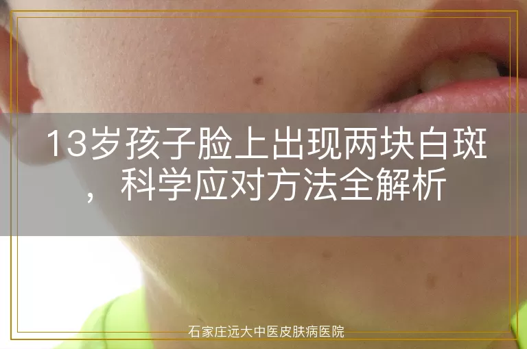 13岁孩子脸上出现两块白斑，科学应对方法全解析