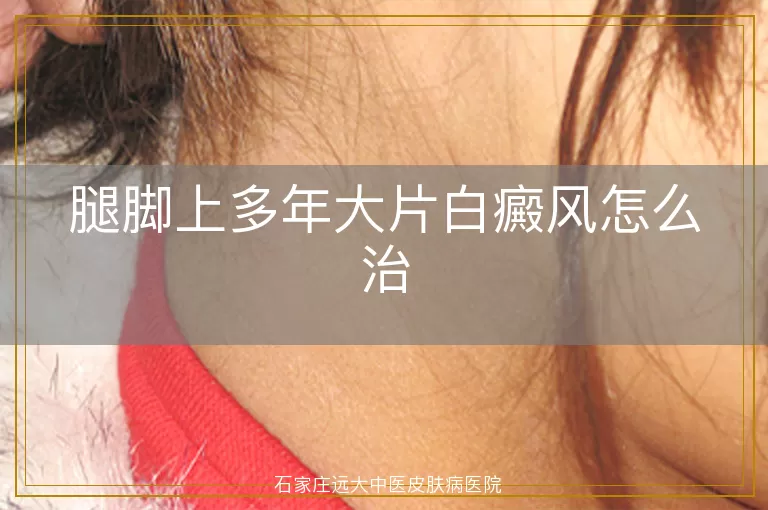 腿脚上多年大片白癜风怎么治