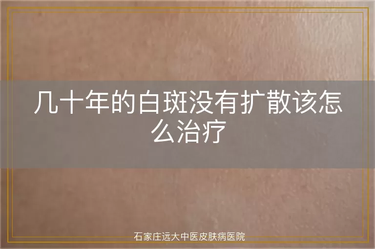 几十年的白斑没有扩散该怎么治疗