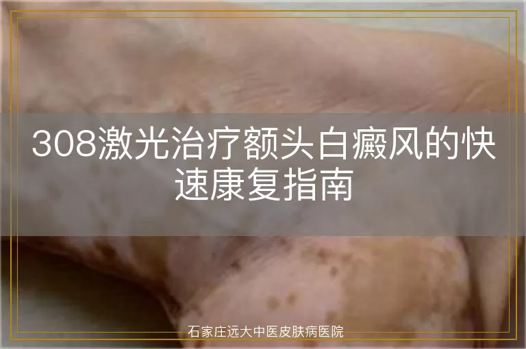 308激光治疗额头白癜风的快速康复指南